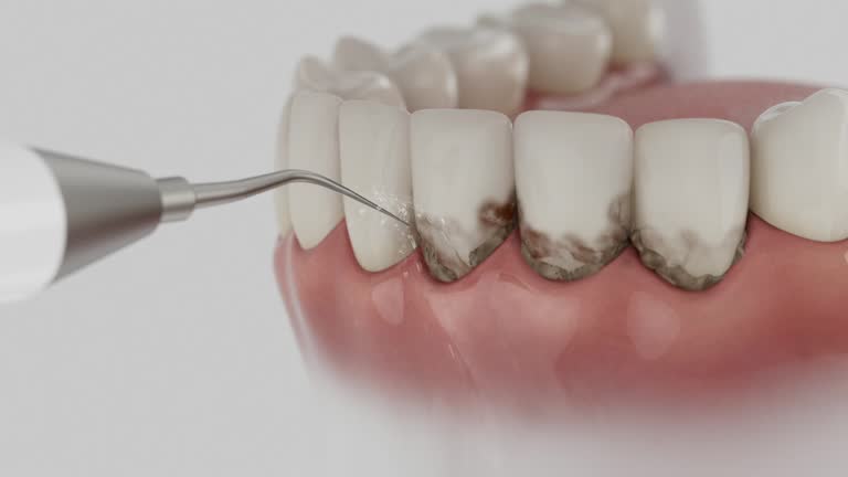 Trusted Wisdom Tooth Removal service in Somerville, MA - Dentist Open Now